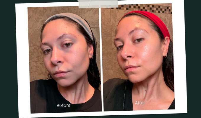Lyma Laser Review: Original before and after photos of Stephanie Maida