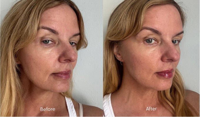 upneeq-eye-drops-review-before-and-after